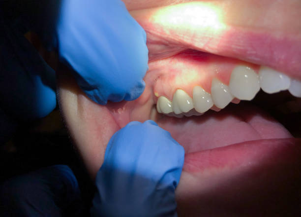 Best Tooth Infection Emergency Dentist  in Chesterbrook, PA
